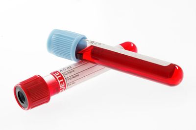 Laboratory hemolysis medical tubes analysis