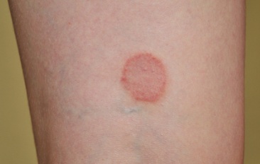 plaque rouge circulaire sur une peau humaine-zoonoses