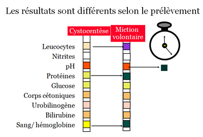 Dépistage de l'infection urinaire par la bandelette urinaire