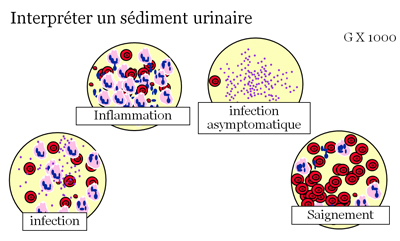 Intérêt de l'analyse des urines dans le diagnostic des infections ...