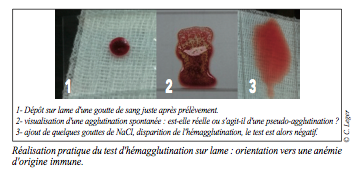 test sanguin sur lame de verre - anemie