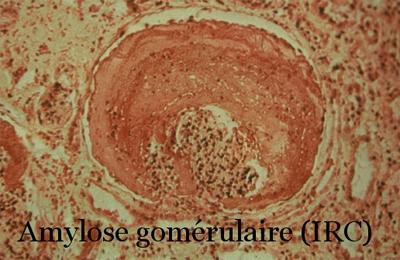 amylose-microscope-insuffisance renale