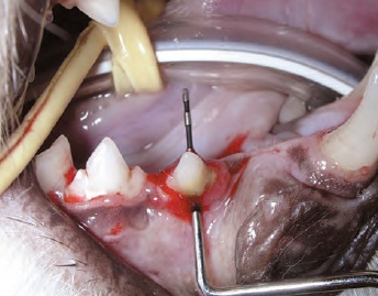 gencive lesion furcation - maladie parodontale
