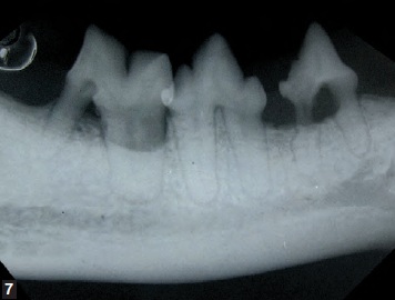 radio intra-orale - maladie parodontale