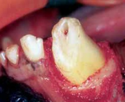 dent elongation coronaire-traumatismes dentaires