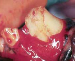 fracture dent extension sous gingivale-traumatismes dentaires