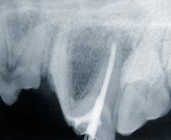 radio fracture dent-traumatismes dentaires