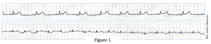 electrocardiogramme - arythmies cardiaques