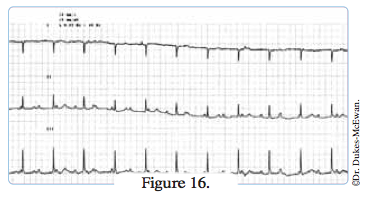 electrocardiogramme - arythmies cardiaques