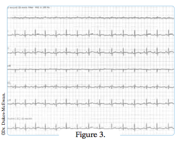 electrocardiogramme 6 pistes - arythmies cardiaques