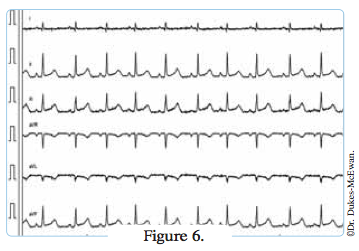 electrocardiogramme chat cardiomyopathe - arythmies cardiaques