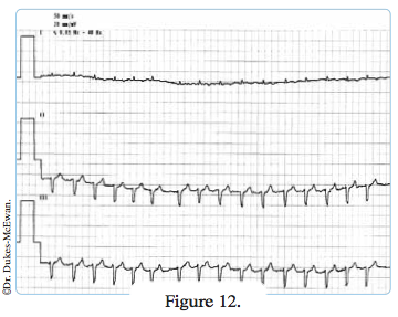 electrocardiogramme - arythmies cardiaques
