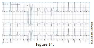 electrocardiogramme - arythmies cardiaques