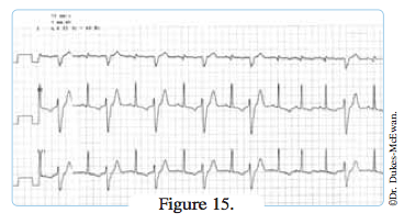 electrocardiogramme - arythmies cardiaques