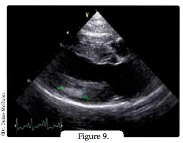 echographie - arythmies cardiaques