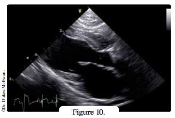 echographie coeur - arythmies cardiaques