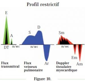 graphique profil restrictif - cardiomyopathie restrictive