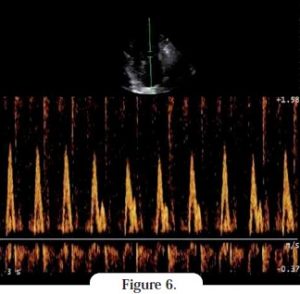 doppler - cardiomyopathie restrictive