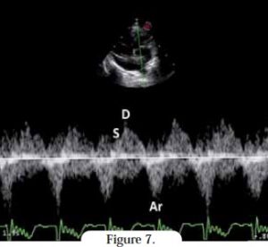 doppler - cardiomyopathie restrictive