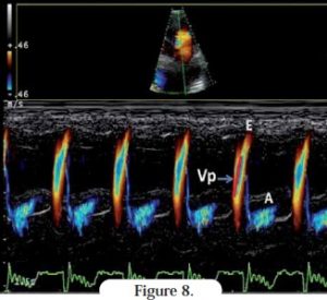 doppler - cardiomyopathie restrictive