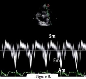 doppler tissulaire - cardiomyopathie restrictive