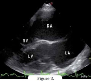 echographie coeur - cardiomyopathie restrictive