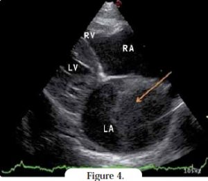 echographie coeur - cardiomyopathie restrictive