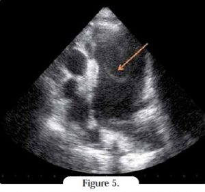 echographie coeur - cardiomyopathie restrictive