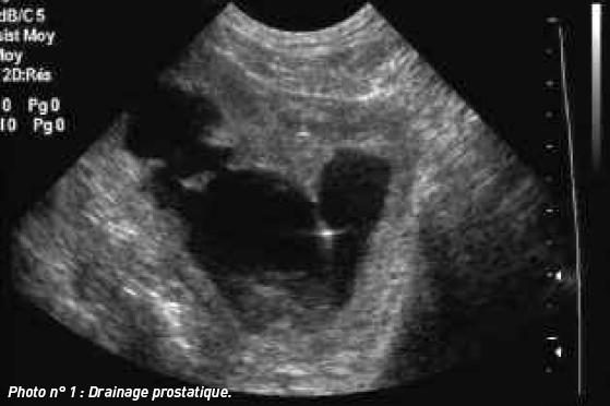 ceaiuri pentru prostatita cronica tratamentul prostatitei de către su jok