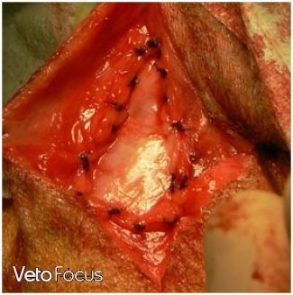 points de suture - hernie perineale