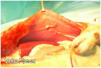 intervention chirurgicale abdominale - hernie perineale