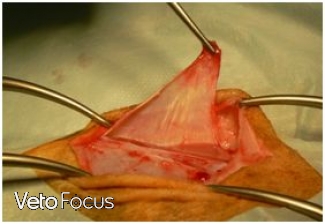 prelevement tissu fascia lata - hernie perineale