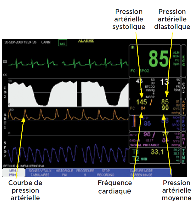 courbes de mesures sur ecran - mesure pression arterielle