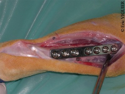 stabilisation radius plaque en fer - osteosynthese