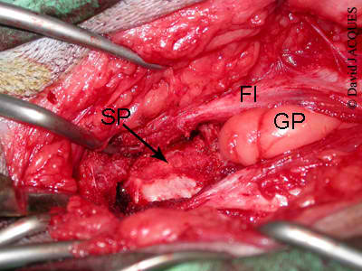 incision fascia - symphysiodese pubienne juvenile