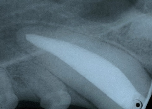 radio dent - traumatismes dentaires