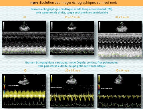 evolution images echographique - persistance canal arteriel