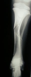 radio fracture tibia - ostéosynthese élastique