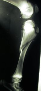 radio fracture -osteosynthese elastique