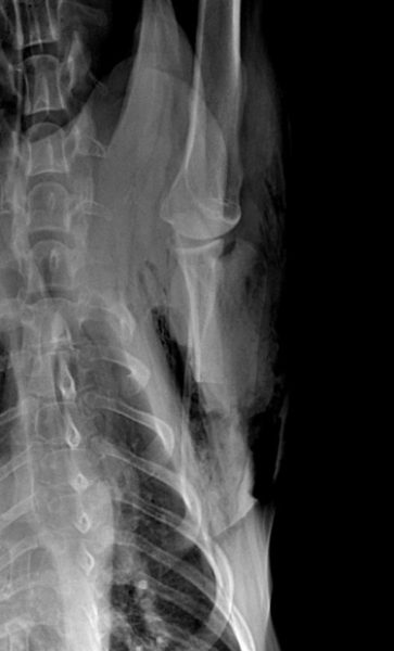 radio thoracique de face apres operation suite chondrosarcome