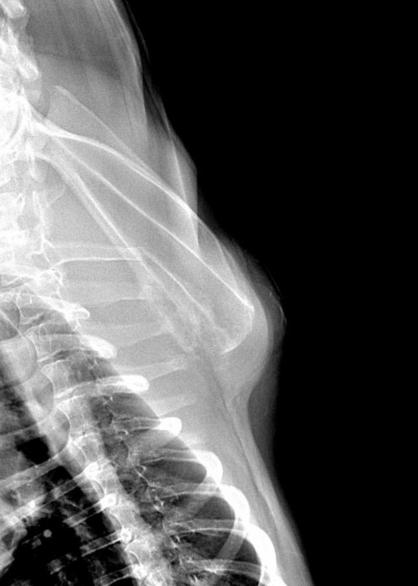 radiographie scapula gauche déformée avec chondrosarcome