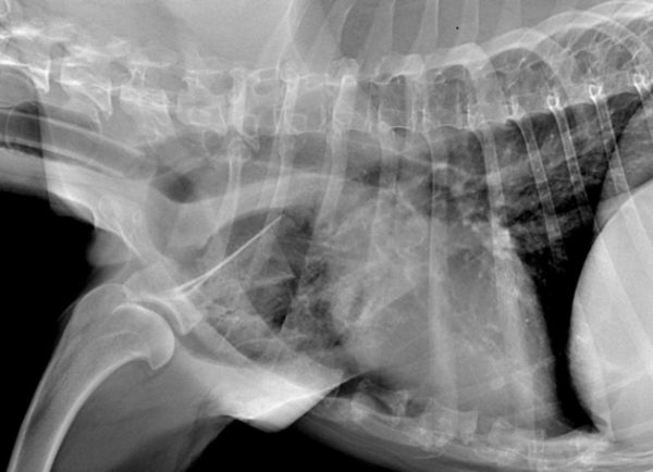 radio de la scapula de profil apres intervention suite chondrosarcome