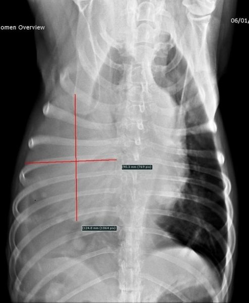 radio du thorax de face laissant apparaitre tumeurs dans abdomen cinq mois apres intervention suite chondrosarcome