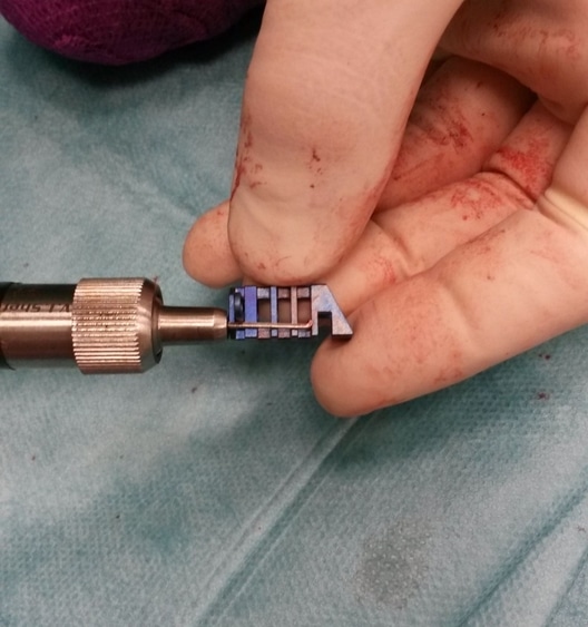 main du chirurgien tenant la cage choisie pour l'acte chirurgical de tibial tuberosity advancement