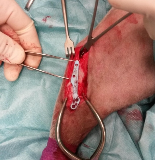 pose plaque metal sur os par chirurgien suite tibial tuberosity advancement