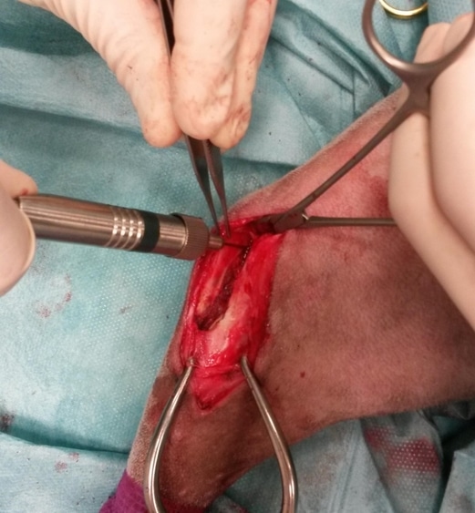 partie de l'os découpée retirée et mesure de profondeur avec outil adapté suite tibial tuberosity advancement