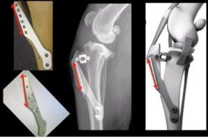 Lire la suite à propos de l’article Tibial Tuberosity Advancement
