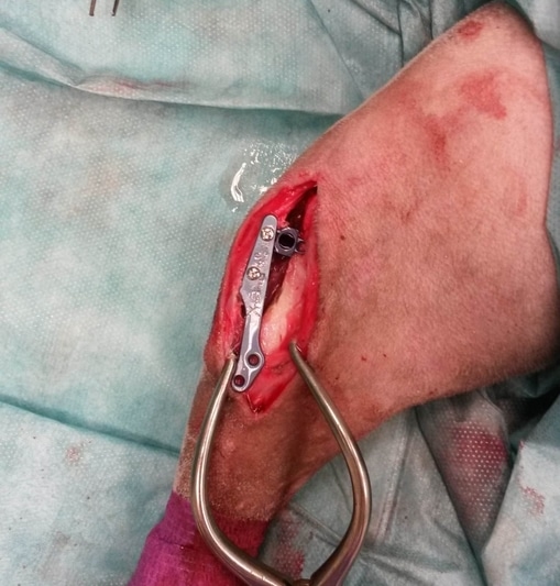 cage implantée et pose d'une plaque metal à visser suite tibial tuberosity advancement