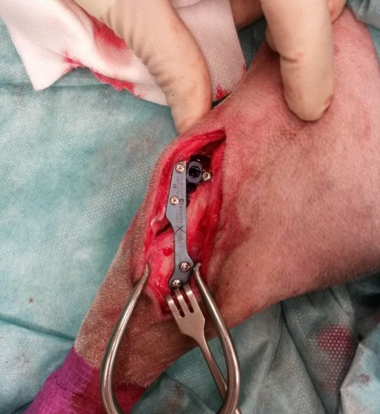 plaque vissée de part et d'autre de la partie du tibia découpée